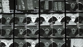 Israeli study points to potential breakthrough in spinal cord injury care